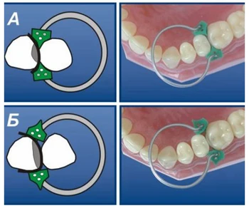 100Pcs/Set Dental Sectional Design Matricer Matrix Ring Delta+40Pcs Add-On Kile