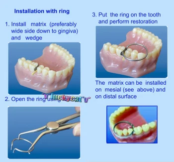 Dental 100Pcs Sectional Design Matricer Matrix Ring Delta1.398 + 40pc Add-On Kiler NR.1.861