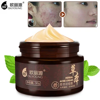 Plantestoffer Acne Creme Anti Bums Stedet Acne Ar Hudorm Fjernelse Whitening Cream Beauty Skin Face Pleje Cremer Acne Behandling